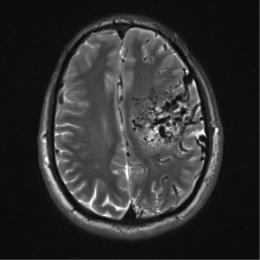 File:Cerebral arteriovenous malformation - huge (Radiopaedia 35734-37272 Axial T2 16).png