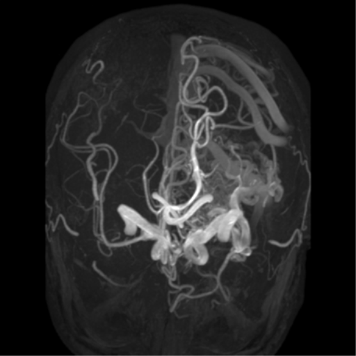 File:Cerebral arteriovenous malformation - huge (Radiopaedia 35734-37272 MRA 16).png