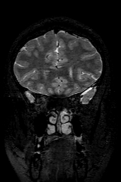 Cerebral arteriovenous malformation at posterior body of corpus callosum (Radiopaedia 74111-84925 Coronal T2 45).jpg