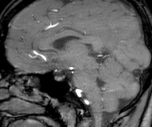Cerebral arteriovenous malformation at posterior body of corpus callosum (Radiopaedia 74111-84925 J 207).jpg
