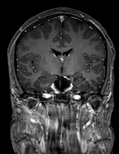Cerebral arteriovenous malformation at posterior body of corpus callosum (Radiopaedia 74111-84925 K 173).jpg