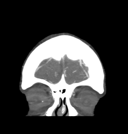 Cerebral arteriovenous malformation with lobar hemorrhage (Radiopaedia 44725-48511 B 7).png