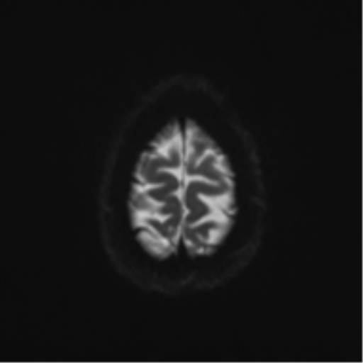 File:Cerebral cavernoma and development venous anomaly (Radiopaedia 37603-39482 Axial DWI 21).png