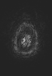 File:Cerebral cavernoma and development venous anomaly (Radiopaedia 37603-39482 Axial SWI 40).png