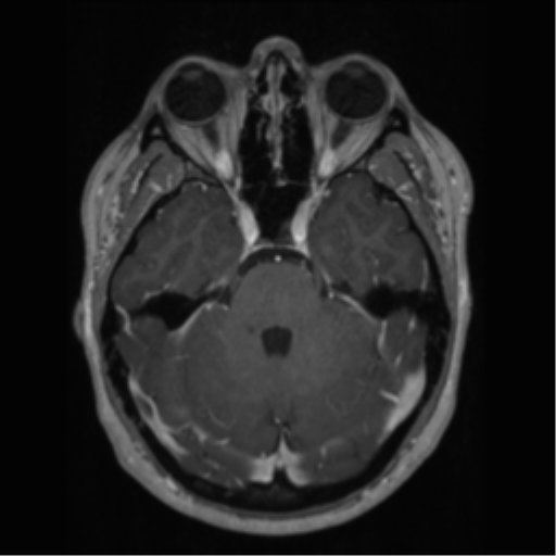 Cerebral cavernoma and development venous anomaly (Radiopaedia 37603-39482 Axial T1 C+ 24).png