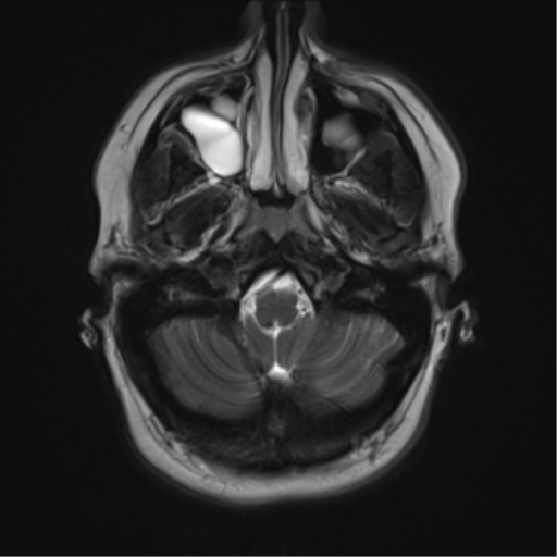 File:Cerebral cavernoma and development venous anomaly (Radiopaedia 37603-39482 Axial T2 3).png