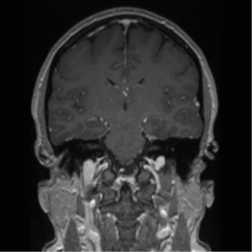 Cerebral cavernoma and development venous anomaly (Radiopaedia 37603-39482 Coronal T1 C+ 46).png