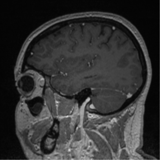Cerebral cavernoma and development venous anomaly (Radiopaedia 37603-39482 Sagittal T1 C+ 69).png