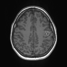 File:Cerebral cavernous venous malformation (Radiopaedia 70008-80021 Axial T1 59).jpg