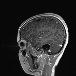 File:Cerebral cavernous venous malformation (Radiopaedia 70008-80021 Sagittal T1 C+ 57).jpg