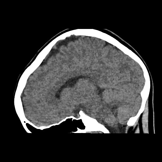 File:Cerebral cavernous venous malformation (Radiopaedia 70008-80022 C 32).jpg