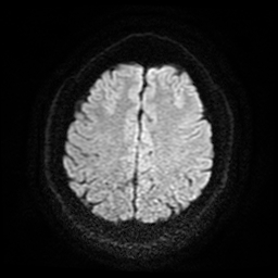 File:Cerebral cavernous venous malformation (Zabramski type II) (Radiopaedia 85511-101198 Axial DWI 56).jpg