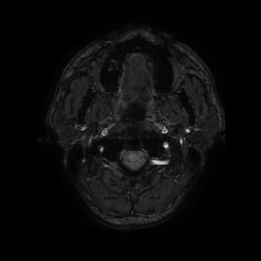 Cerebral cavernous venous malformation (Zabramski type II) (Radiopaedia 85511-101198 Axial SWI 2).jpg