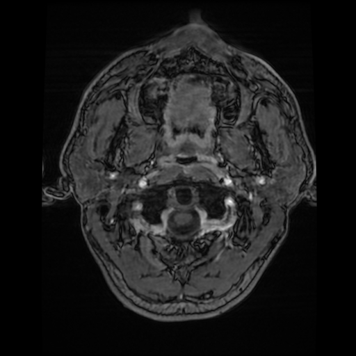Cerebral cavernous venous malformation (Zabramski type II) (Radiopaedia 85511-101198 Axial T1 C+ fat sat 83).jpg