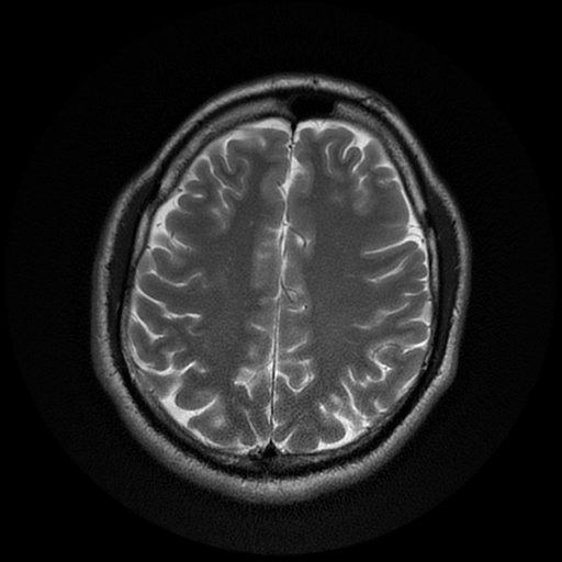 File:Cerebral cavernous venous malformation (Zabramski type II) (Radiopaedia 85511-101198 Axial T2 23).jpg