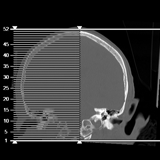 File:Cerebral contusions, subarachnoid hemorrhage and subdural hygromas (Radiopaedia 55399-61827 Axial bone window 1).png