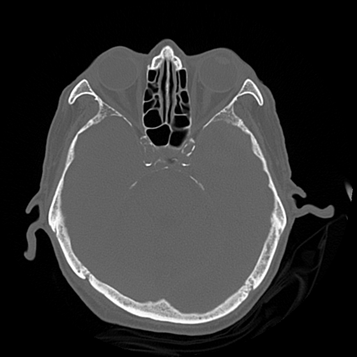 Cerebral contusions, subarachnoid hemorrhage and subdural hygromas (Radiopaedia 55399-61827 Axial bone window 18).png