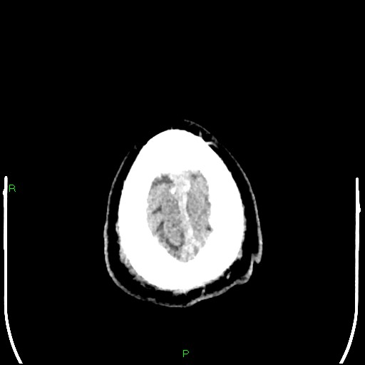 Cerebral contusions (Radiopaedia 33868-35039 Axial non-contrast 209).jpg