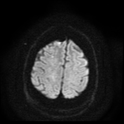 Cerebral embolic infarcts (embolic shower) (Radiopaedia 49837-55108 Axial DWI 57).jpg