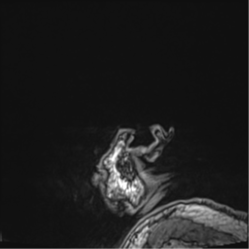 Cerebral embolic infarcts (embolic shower) (Radiopaedia 57395-64342 Sagittal T1 7).png