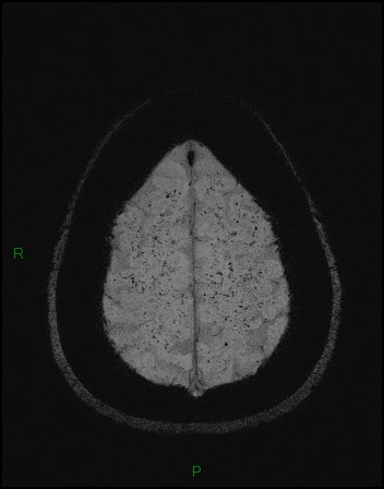 Cerebral fat embolism (Radiopaedia 35022-36525 Axial SWI 53).jpg