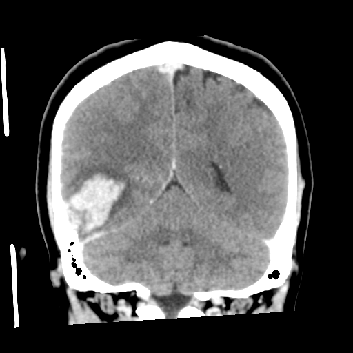 Cerebral hemorrhage secondary to arteriovenous malformation (Radiopaedia 33497-34561 C 47).png