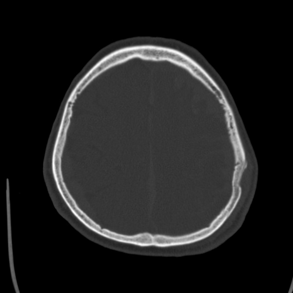 Cerebral hemorrhagic contusions (Radiopaedia 23145-23188 Axial bone window 45).jpg