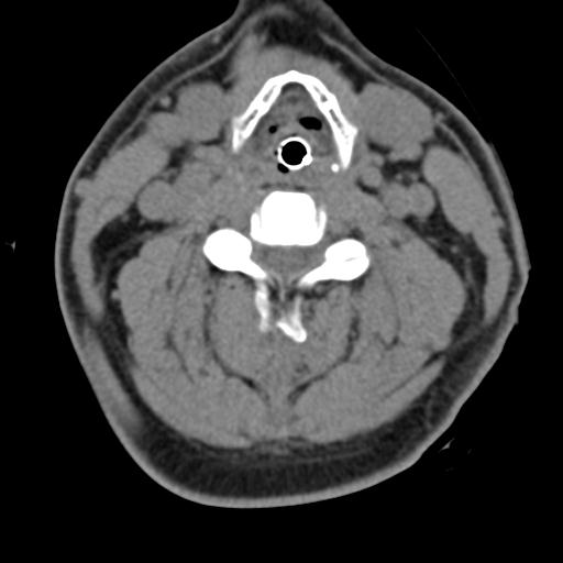 Cerebral hemorrhagic contusions and cervical spine fractures (Radiopaedia 32865-33841 F 28).jpg