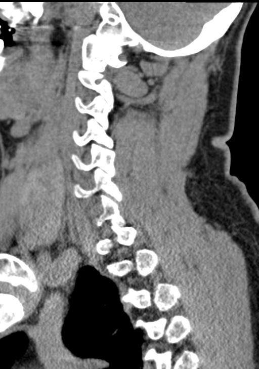 Cerebral hemorrhagic contusions and cervical spine fractures (Radiopaedia 32865-33841 G 74).jpg