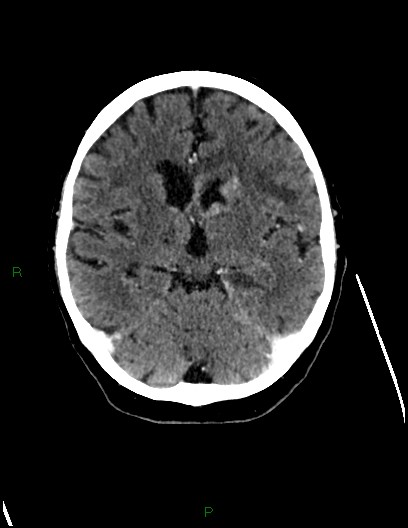 Cerebral metastases - ependymal and parenchymal (Radiopaedia 79877-93131 Axial C+ delayed 39).jpg