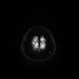 Cerebral metastases - melanoma (Radiopaedia 80972-94522 Axial DWI 93).jpg