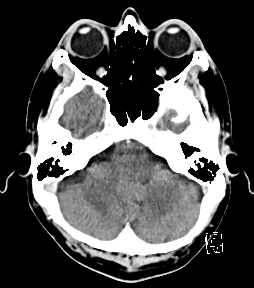 Cerebral metastases - testicular choriocarcinoma (Radiopaedia 84486-99855 Axial C+ delayed 43).jpg