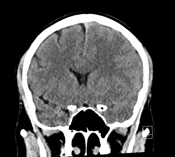 Cerebral metastases - testicular choriocarcinoma (Radiopaedia 84486-99855 Coronal C+ delayed 25).jpg