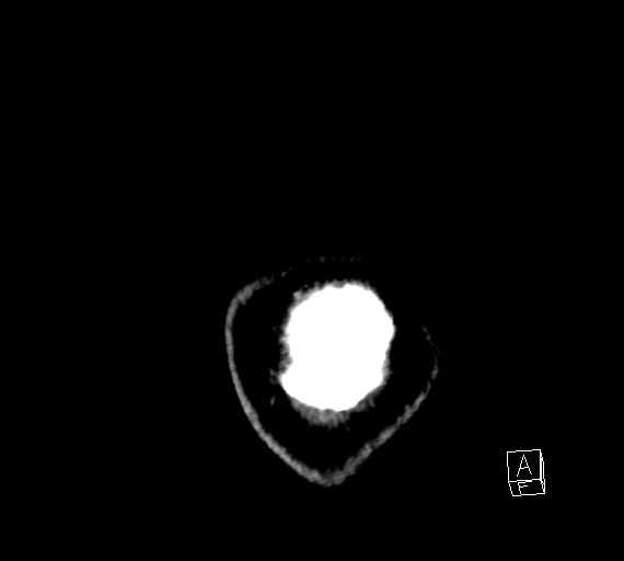 Cerebral metastases - testicular choriocarcinoma (Radiopaedia 84486-99855 D 65).jpg