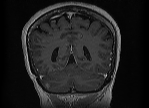 File:Cerebral metastases from lung cancer with amyloid angiopathy and cerebellopontine angle meningioma (Radiopaedia 74306-85191 Coronal T1 C+ 45).jpg