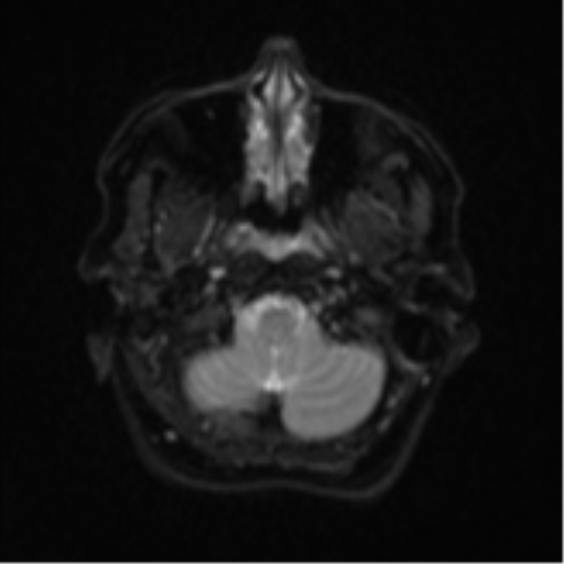 Cerebral metastases mimicking abscesses (Radiopaedia 45841-50131 Axial DWI 5).png