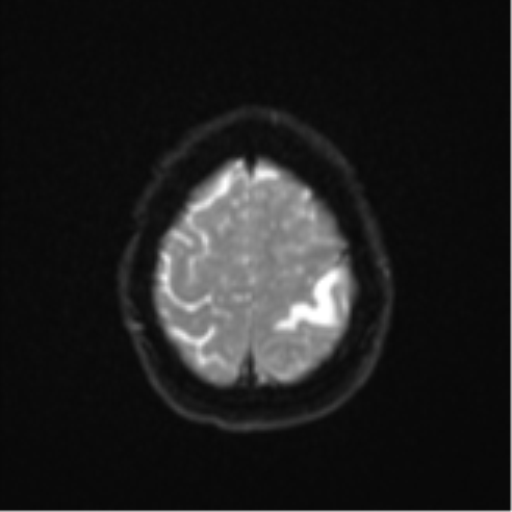 Cerebral metastasis (Radiopaedia 46744-51248 Axial DWI 24).png