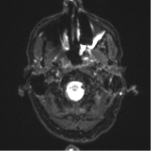 Cerebral metastasis - melanoma (Radiopaedia 54718-60954 Axial DWI 3).png