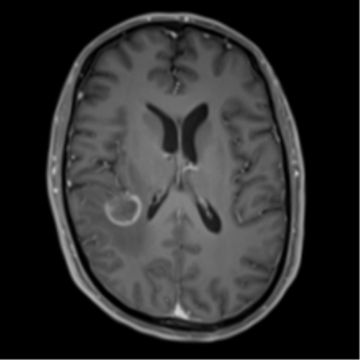 Cerebral metastasis - melanoma (Radiopaedia 54718-60954 Axial T1 C+ fat sat 31).png