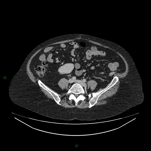 Cerebral metastasis from renal cell carcinoma (Radiopaedia 82306-96378 A 121).jpg