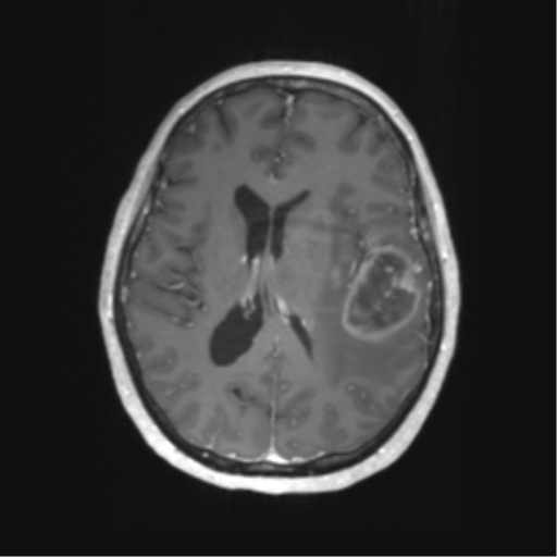 File:Cerebral metastasis mimicking glioblastoma (Radiopaedia 69155-78937 Axial T1 C+ 39).png