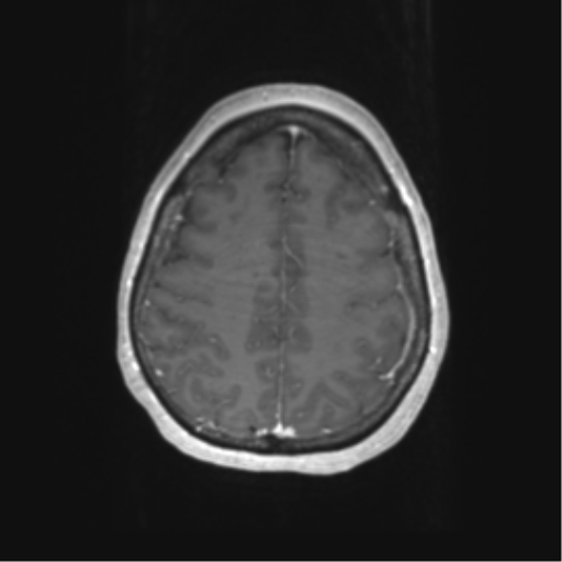 Cerebral metastasis mimicking glioblastoma (Radiopaedia 69155-78937 Axial T1 C+ 53).png