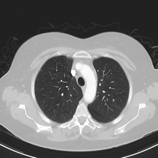 File:Cerebral metastasis mimicking glioblastoma (Radiopaedia 69155-78938 Axial lung window 11).png