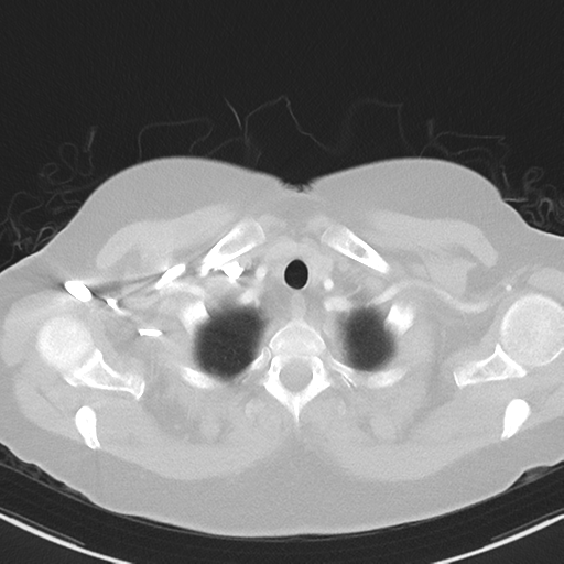 File:Cerebral metastasis mimicking glioblastoma (Radiopaedia 69155-78938 Axial lung window 2).png