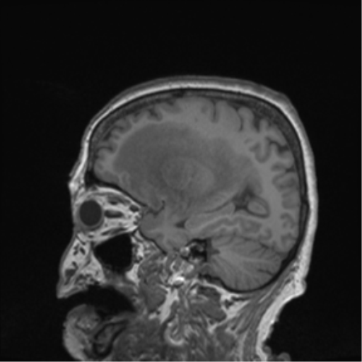 Cerebral metastasis to basal ganglia (Radiopaedia 81568-95413 Sagittal T1 53).png