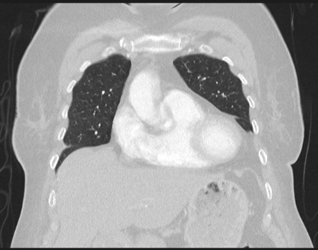 File:Cerebral metastasis to basal ganglia (Radiopaedia 81568-95414 Coronal lung window 27).png