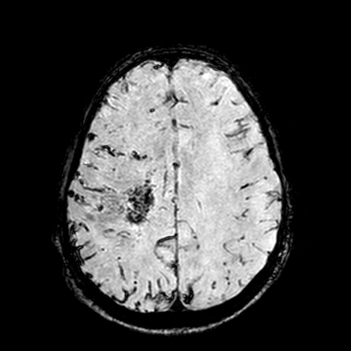 Cerebral parenchymal arteriovenous malformation (Radiopaedia 27280-27456 Axial SWI 83).jpg