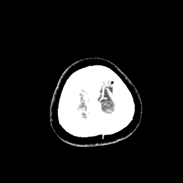 File:Cerebral ring enhancing lesions - cerebral metastases (Radiopaedia 44922-48818 B 277).jpg