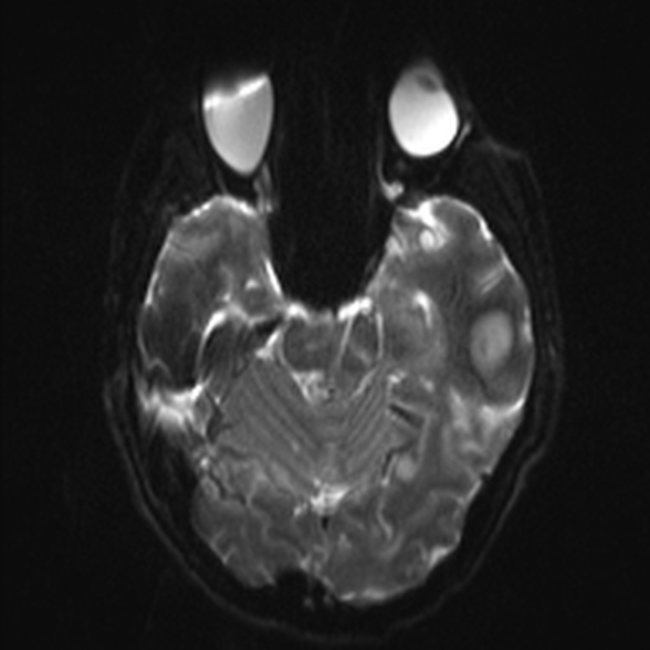 Cerebral toxoplasmosis (Radiopaedia 53993-60132 Axial DWI 9).jpg