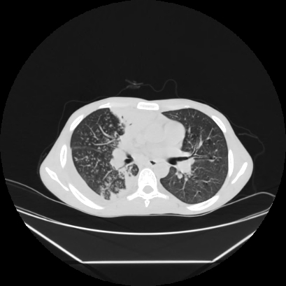 File:Cerebral tuberculoma (Radiopaedia 80829-94318 Axial lung window 81).jpg